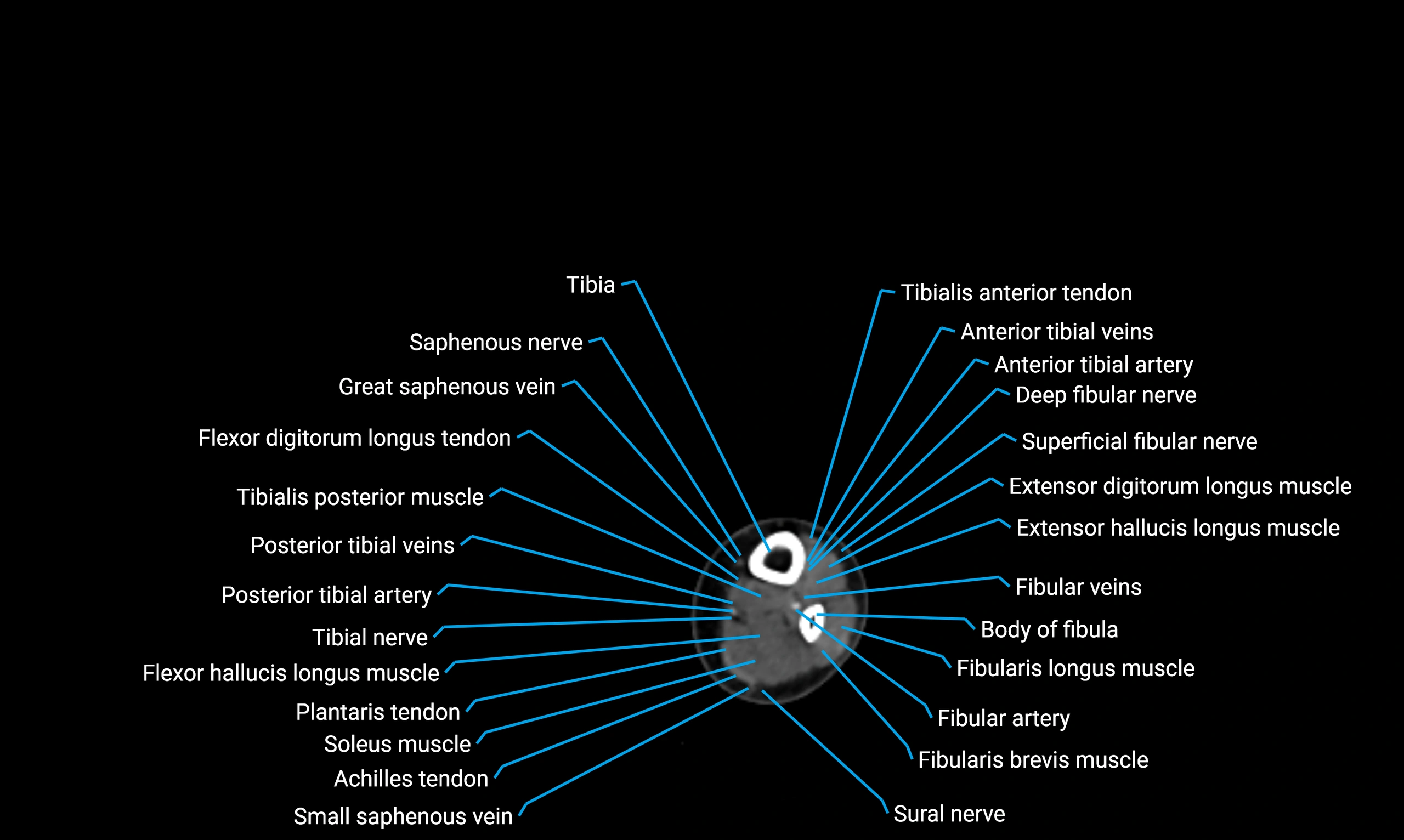 CT lower limb axial cross sectional anatomy labelled image 148 (2).webp